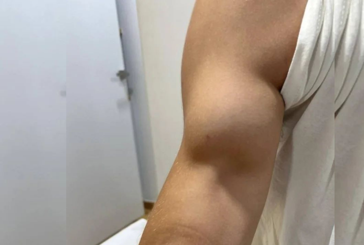 Can I still workout with a torn bicep tendon? It's a question many fitness enthusiasts grapple with after an injury.